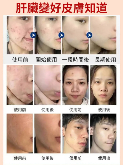 清肝淨肝三清貼-清肝毒，美容養顏，藥房直供，7天解決你的肝問題