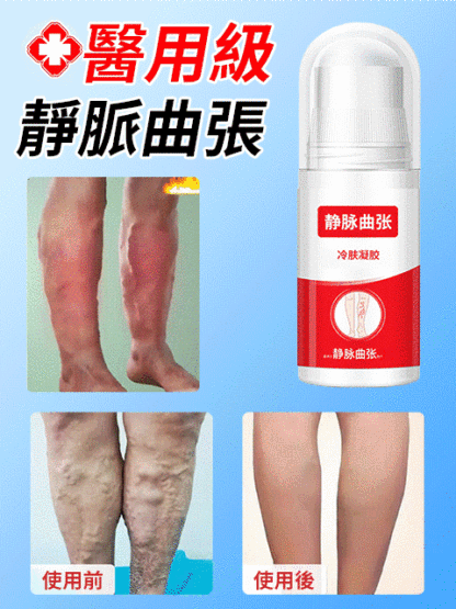 靜脈非曲張冷敷凝膠