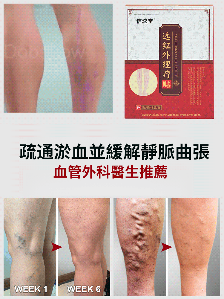 靜脈曲張貼穴位遠紅外線理療貼