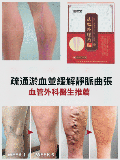 靜脈曲張貼穴位遠紅外線理療貼