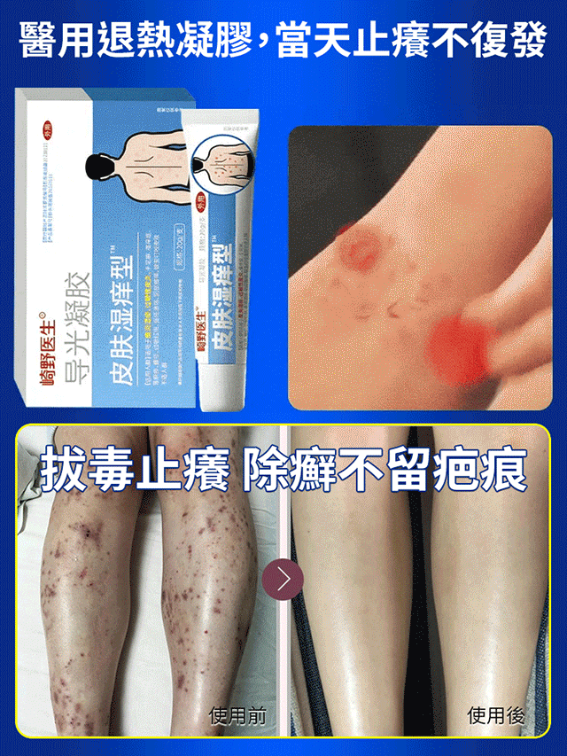 皮膚濕癢型醫用退燒凝膠