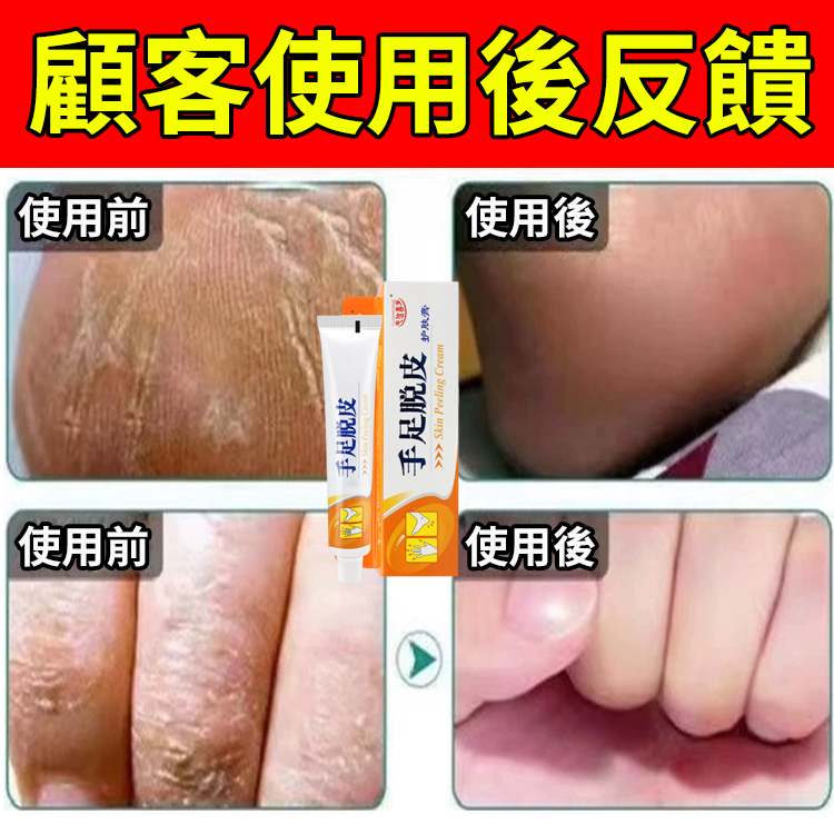 【脫皮專用】手足脫皮抑菌膏,換季必備，手腳乾裂脫皮，乾癢搔癢，老是用手摳反反復復，趕緊用這個
