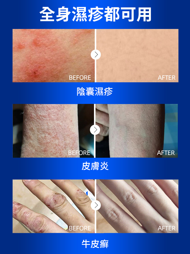 皮膚濕癢型醫用退燒凝膠