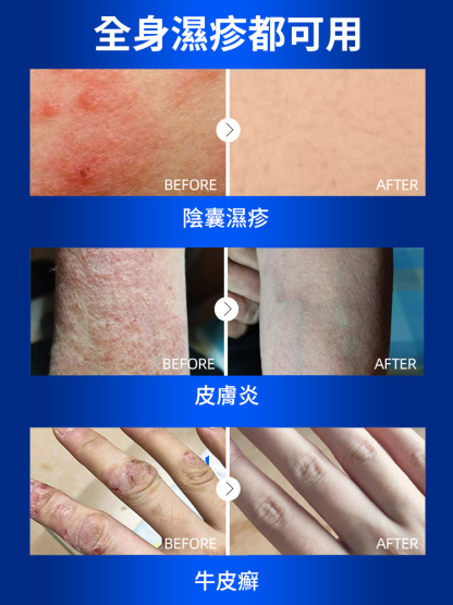 皮膚濕癢型醫用退燒凝膠