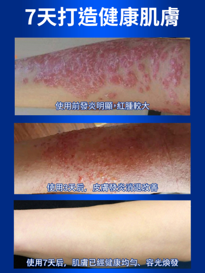 皮膚濕癢型醫用退燒凝膠