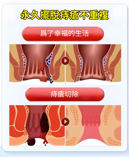 斷痔康痔瘡護理乳膏，痔瘡剋星，台北大學肛肠科醫師推薦，最後一百單特價