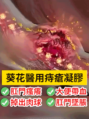 無痛修復醫用痔瘡凝膠-7天消痔瘡，解決你的難言之隱，告別有痔人群