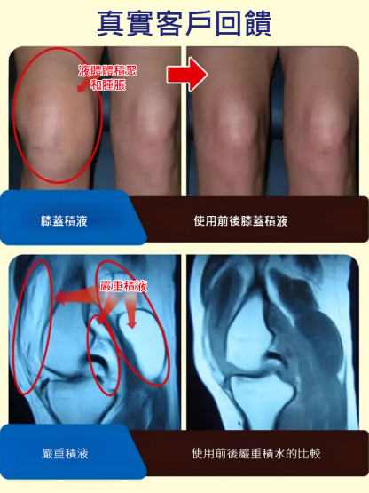 天寶滑膜半月板膏滑膜凝膠