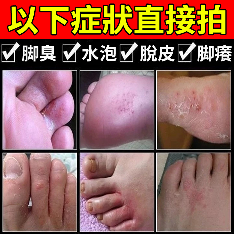 【脫皮專用】手足脫皮抑菌膏,換季必備，手腳乾裂脫皮，乾癢搔癢，老是用手摳反反復復，趕緊用這個