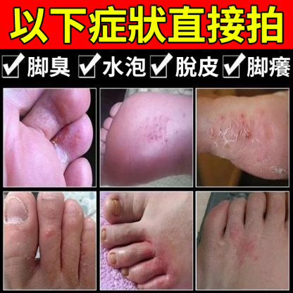 【脫皮專用】手足脫皮抑菌膏,換季必備，手腳乾裂脫皮，乾癢搔癢，老是用手摳反反復復，趕緊用這個