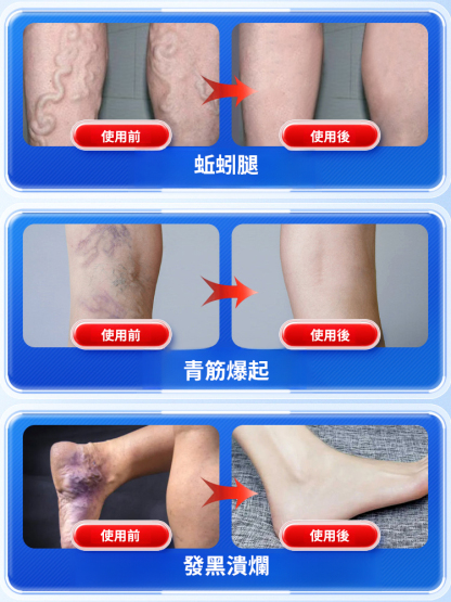 靜脈曲張貼穴位遠紅外線理療貼