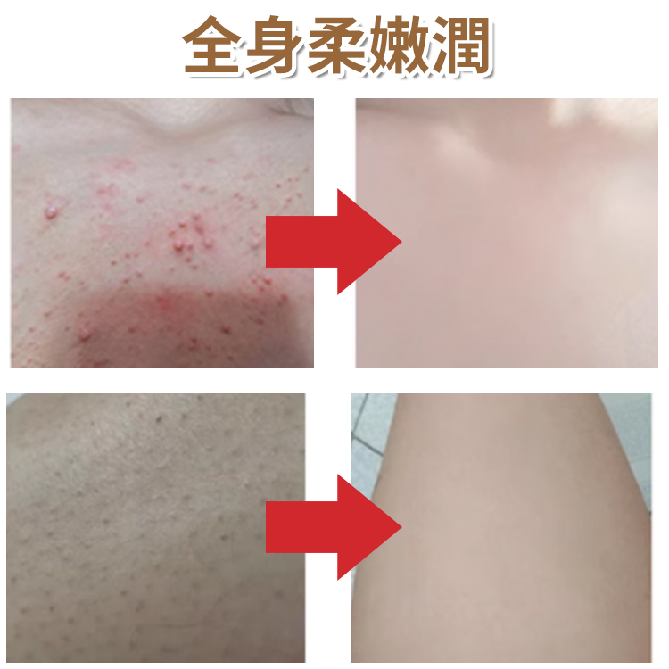 淨痘除蟎硫磺三合一沐浴露