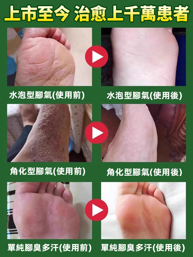 硫磺腳氣王止癢除菌足部護理