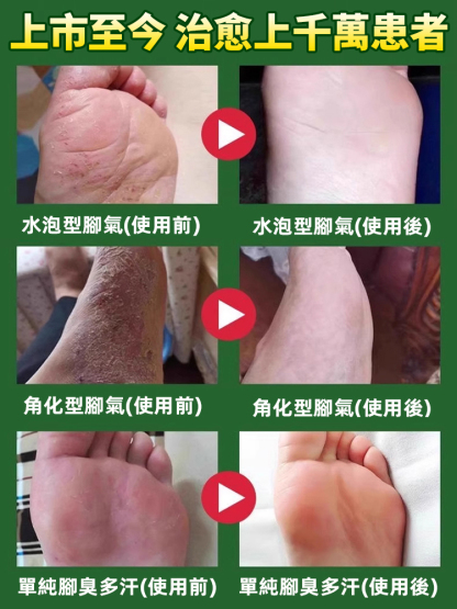 硫磺腳氣王止癢除菌足部護理