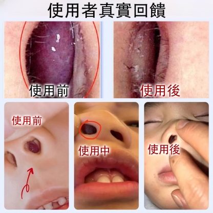 【一貼通暢】鼻炎穴位砭貼