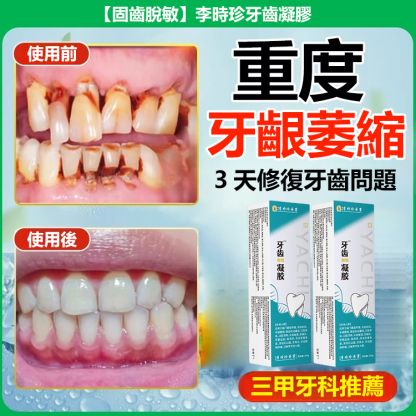 【固齒脫敏】李時珍牙齒凝膠