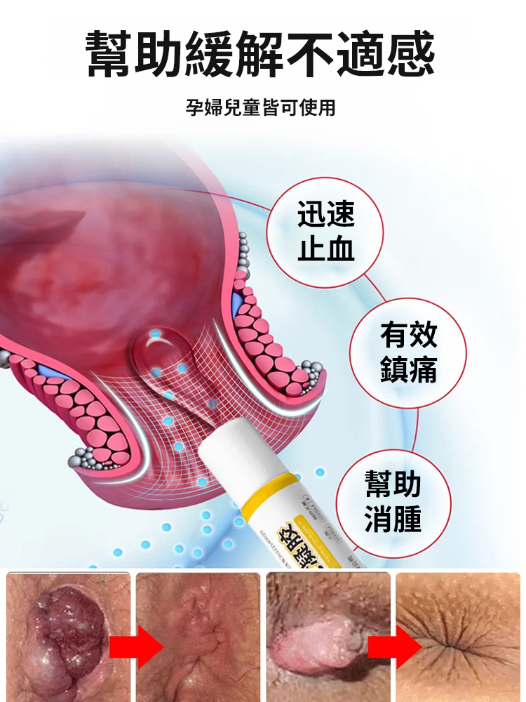 醫方碩消痔凝膠