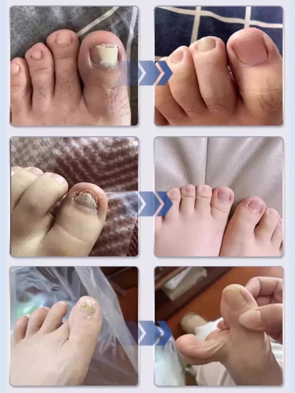 【一週手足灰甲全搞定】醫用灰指甲凝膠