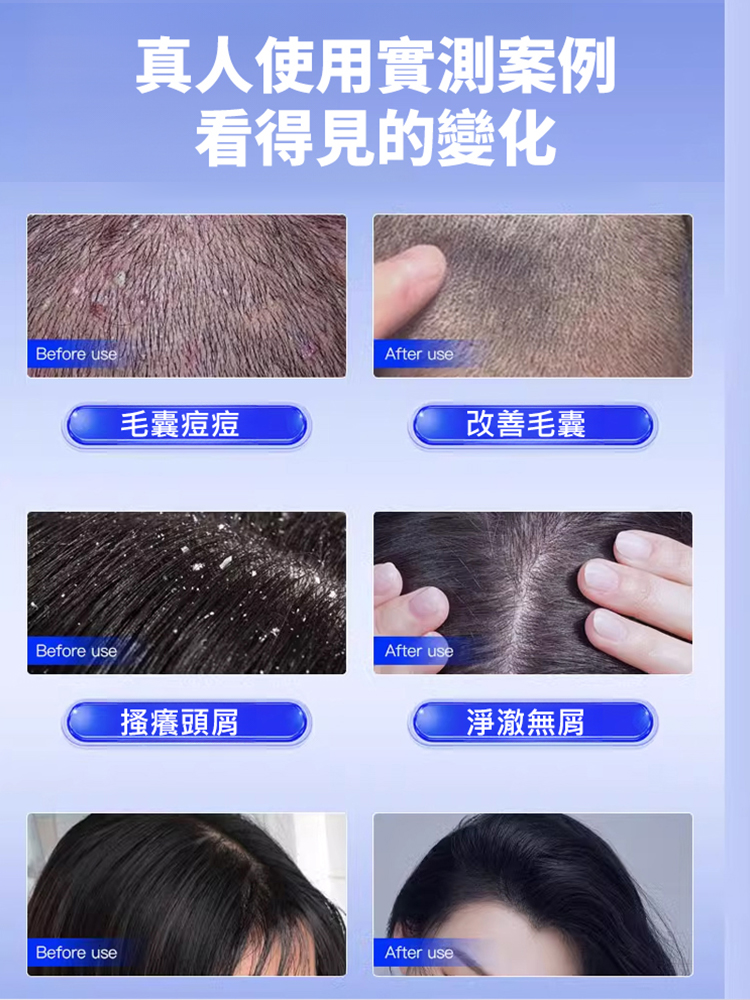 【拯救毛囊炎】二硫化硒去屑洗髮精