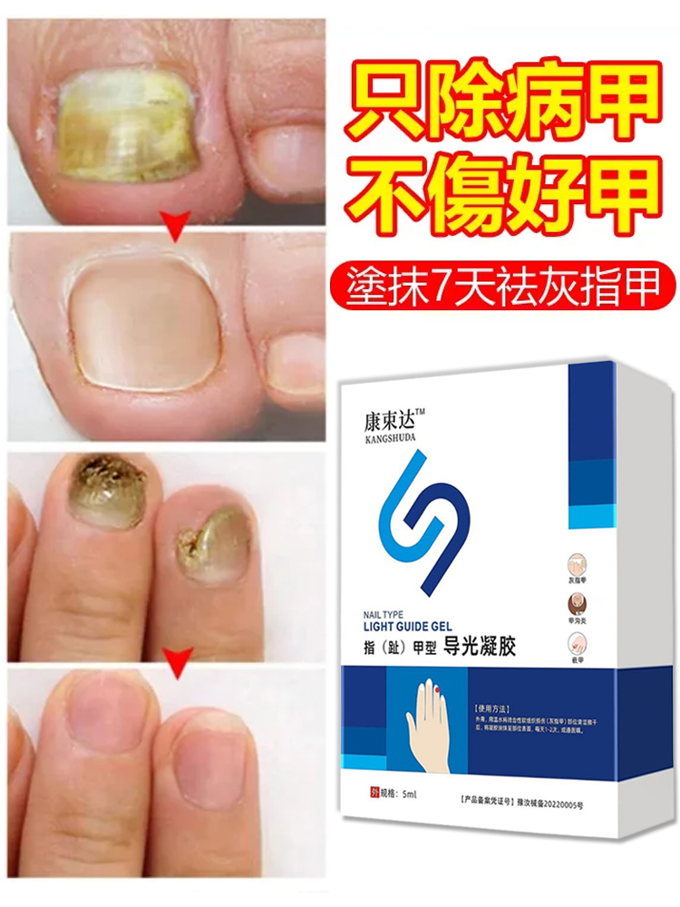 【一週手足灰甲全搞定】醫用灰指甲凝膠