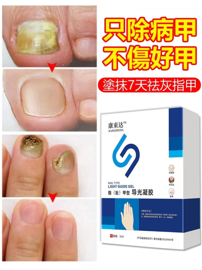 【一週手足灰甲全搞定】醫用灰指甲凝膠