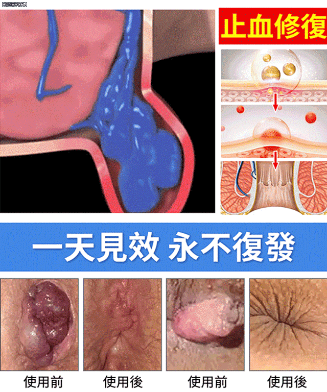 【溫和修護】仁莘護消痔凝膠