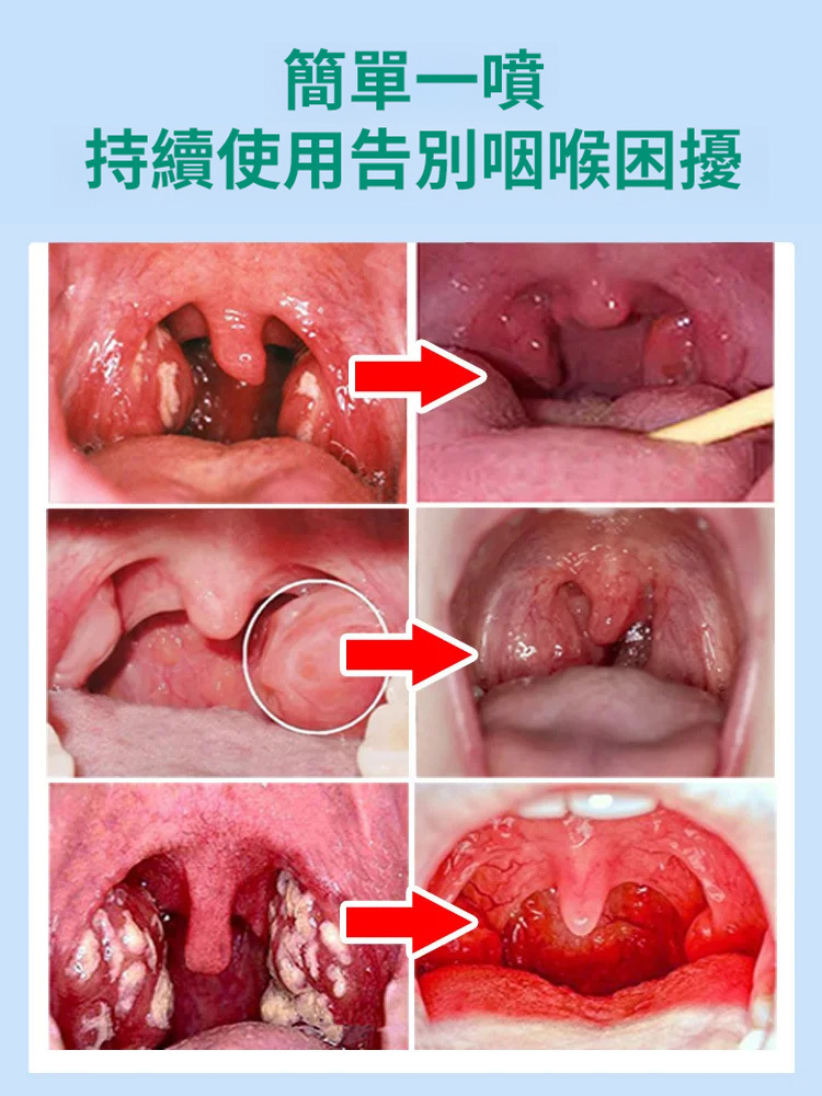咽扁型退燒凝膠