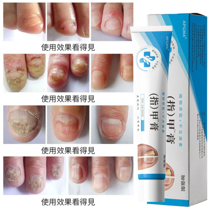 【無痛不復發】灰指甲膏