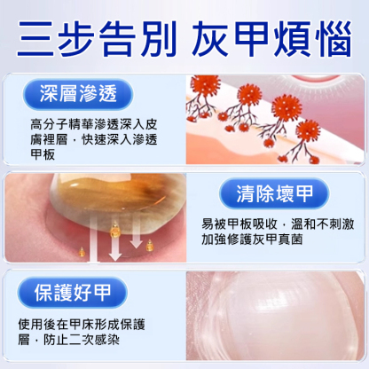 【無痛不復發】灰指甲膏