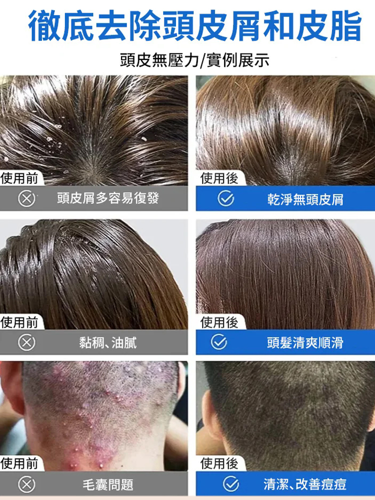 【專攻油痘屑癢】二硫化曬洗髮水