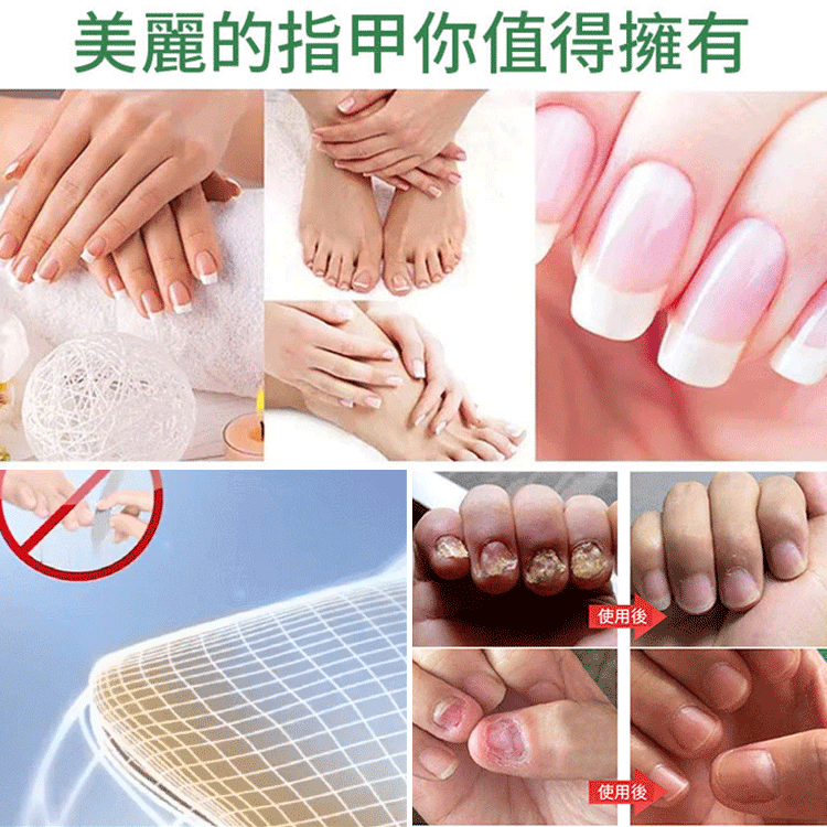 【無痛不復發】灰指甲膏