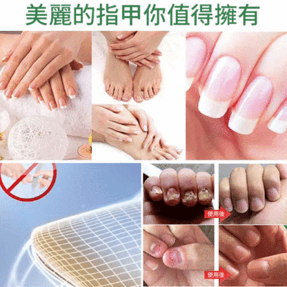 【無痛不復發】灰指甲膏