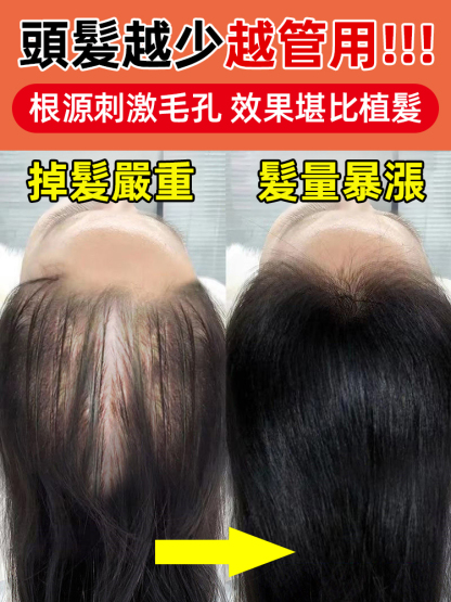 滾珠式按摩防脫髮液