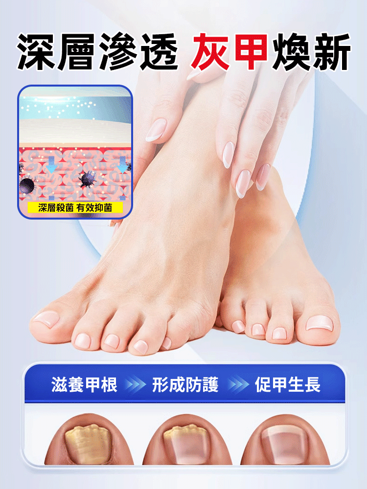 醫用30%冰醋酸3天終結灰甲