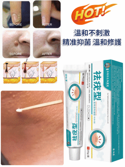 【除疣一抹靈】醫用退熱凝膠疣清寧