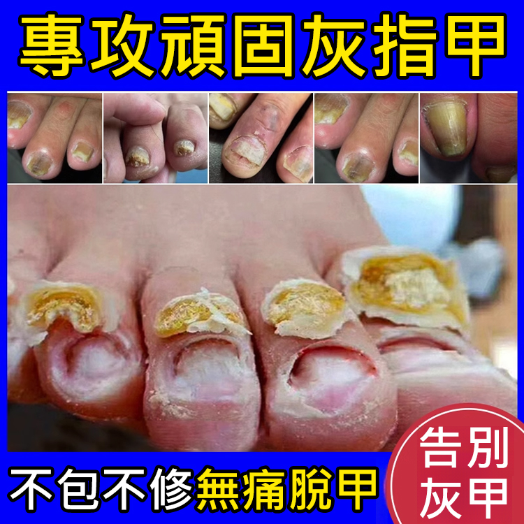 【無痛不復發】灰指甲膏