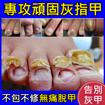 【無痛不復發】灰指甲膏