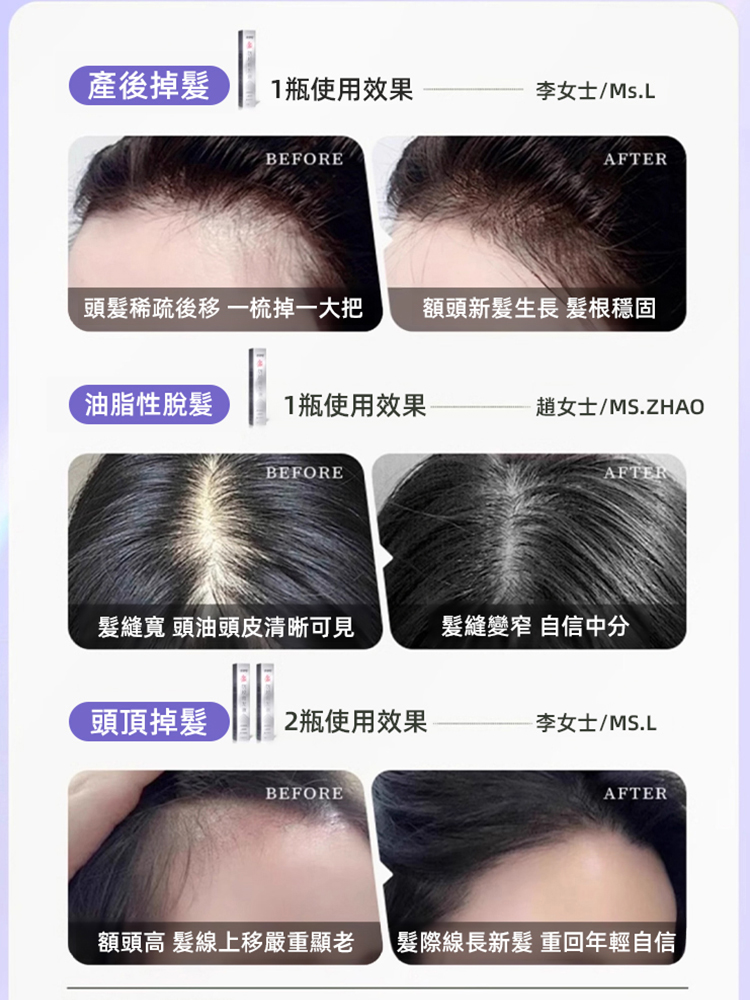 滾珠式按摩防脫髮液