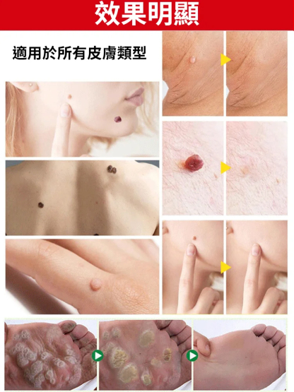 【除疣一抹靈】醫用退熱凝膠疣清寧