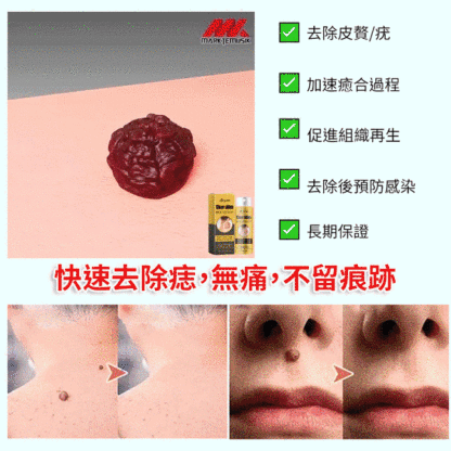 蜂毒克疣護理噴霧