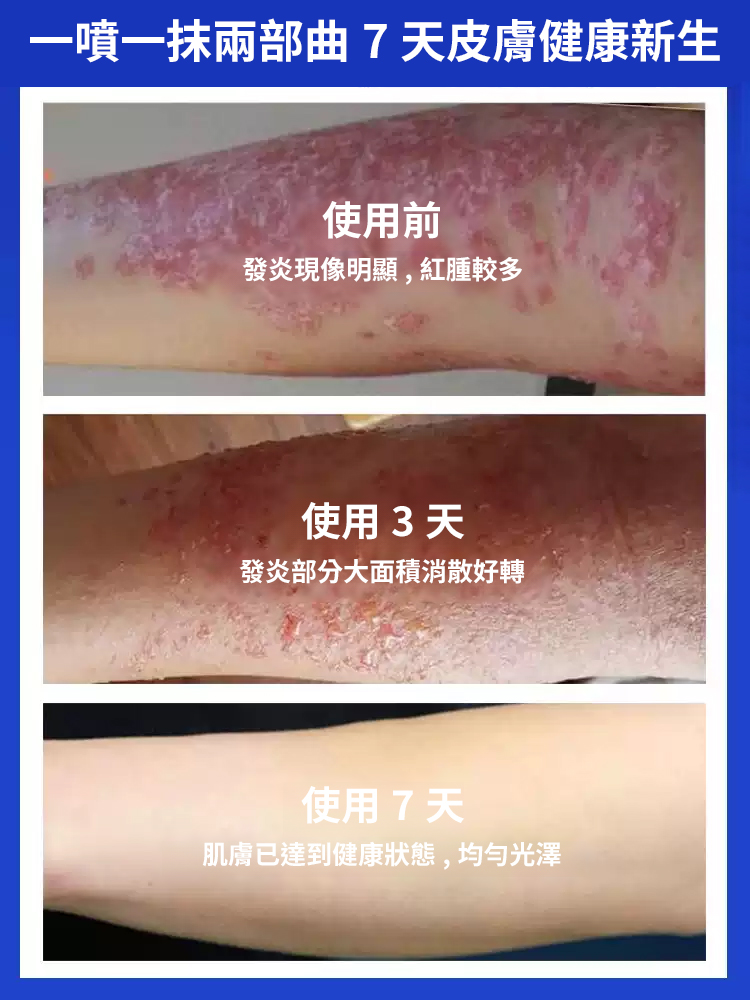 7天斷癢不反覆抑菌濕毒噴劑