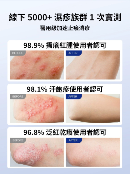 7天斷癢不反覆抑菌濕毒噴劑