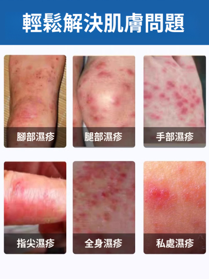 7天斷癢不反覆抑菌濕毒噴劑