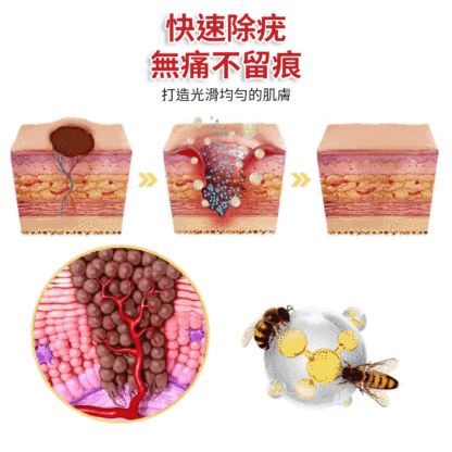 蜂毒克疣護理噴霧