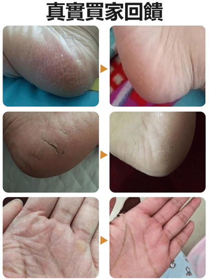 手足護理防皺裂金蛇油膏