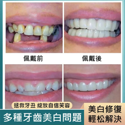 提升笑容美觀假牙套裝