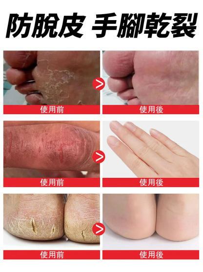 中醫古方手足脫皮抑菌膏手腳乾裂