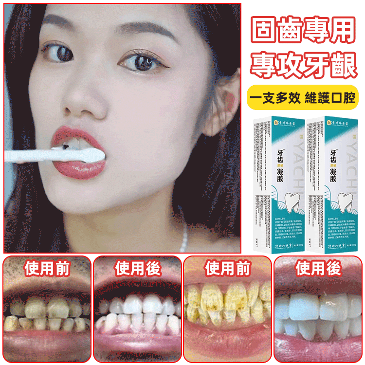 【固齒脫敏】李時珍牙齒凝膠