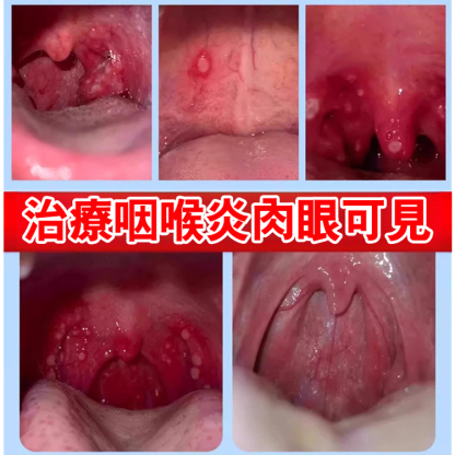 【拒絕咽喉炎反覆】李時珍咽扁凝膠