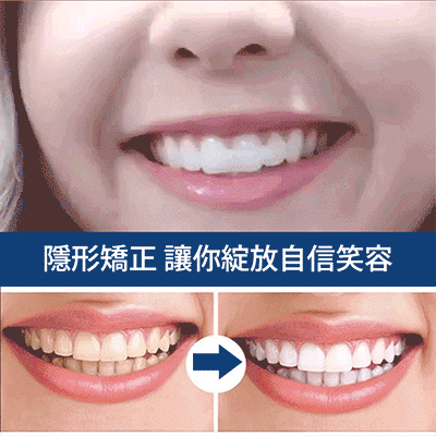 提升笑容美觀假牙套裝